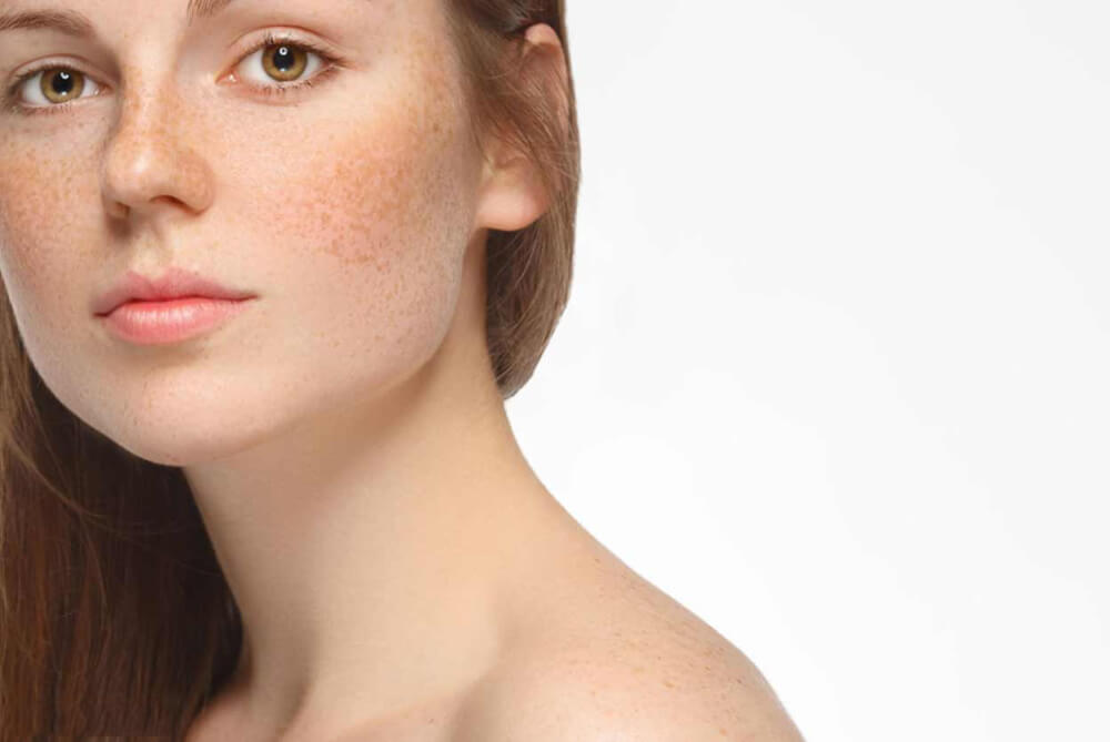 Tăng sắc tố khiến vùng da mặt bị sẫm màu hơn.